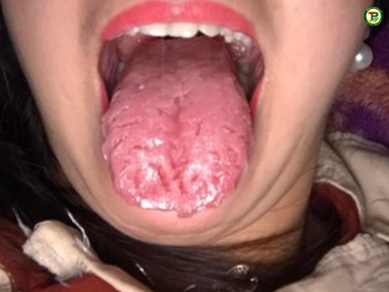 Nấm lưỡi ở người lớn gây ra nứt lưỡi